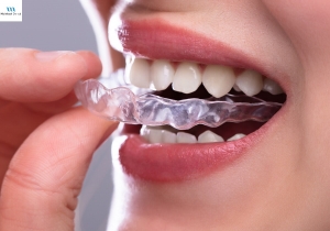 Invisible Braces: Transform Your Smile With Invisalign